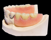 Partial Denture