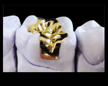 Gold Inlay