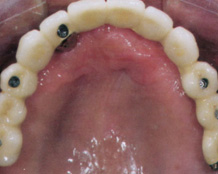 Implant
